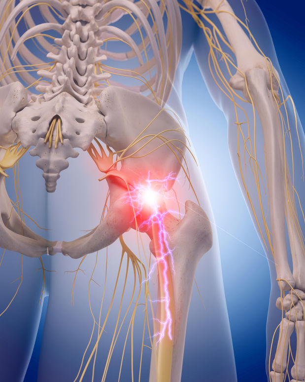 Can Sciatica Cause Hip Pain?
