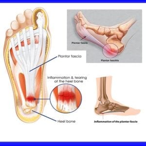 Plantar Fasciitis